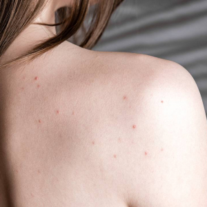 Прыщи оказались одним из признаков редкой опухоли мозга